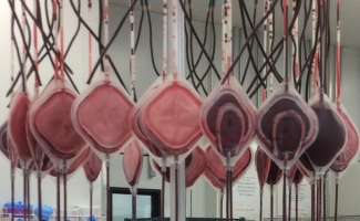 This is a close up of the leukoreduction filters after the blood has passed through.